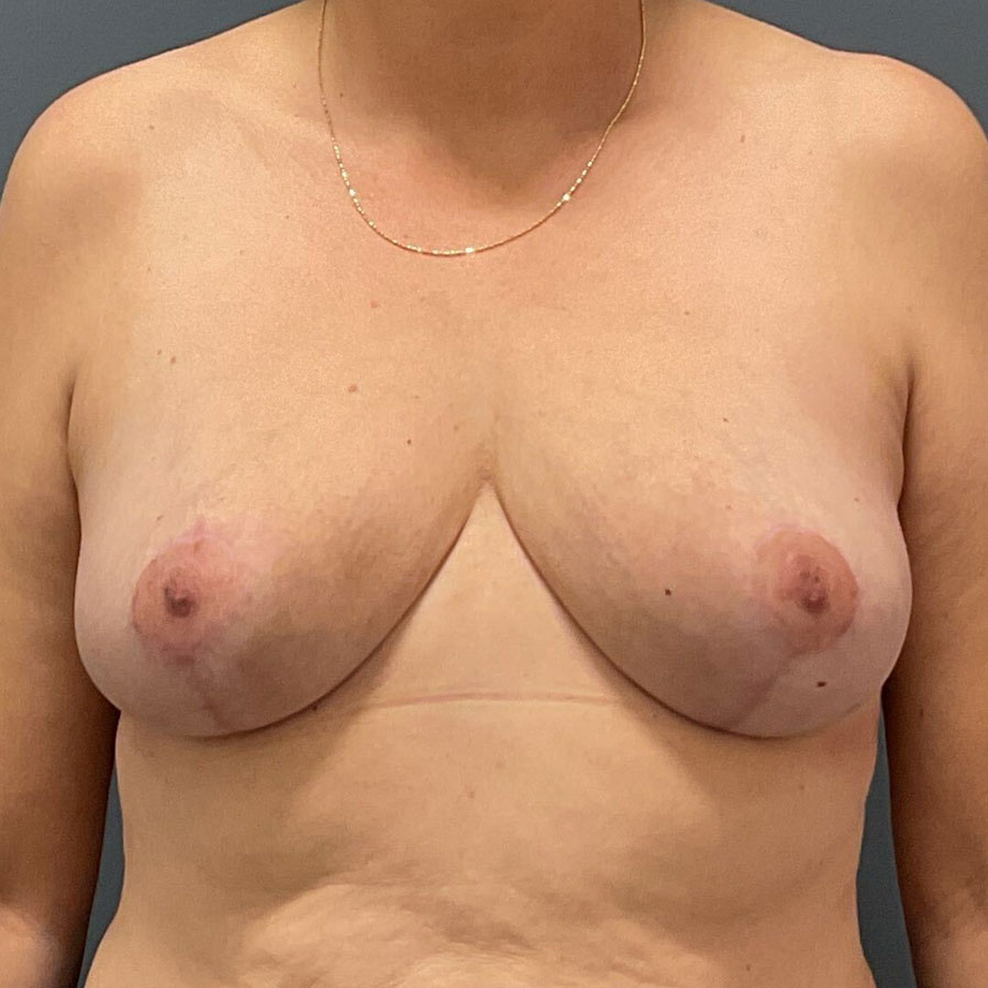 Case--5089 | After Full Correction Explant Surgery (En Bloc plus Fat Grafting w/ Lift) 1