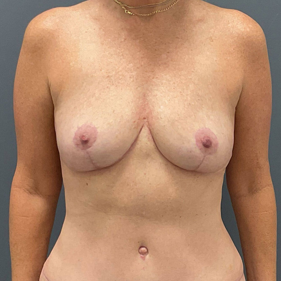 Case--3724 | After Full Correction Explant Surgery (En Bloc plus Fat Grafting w/ Lift) 1