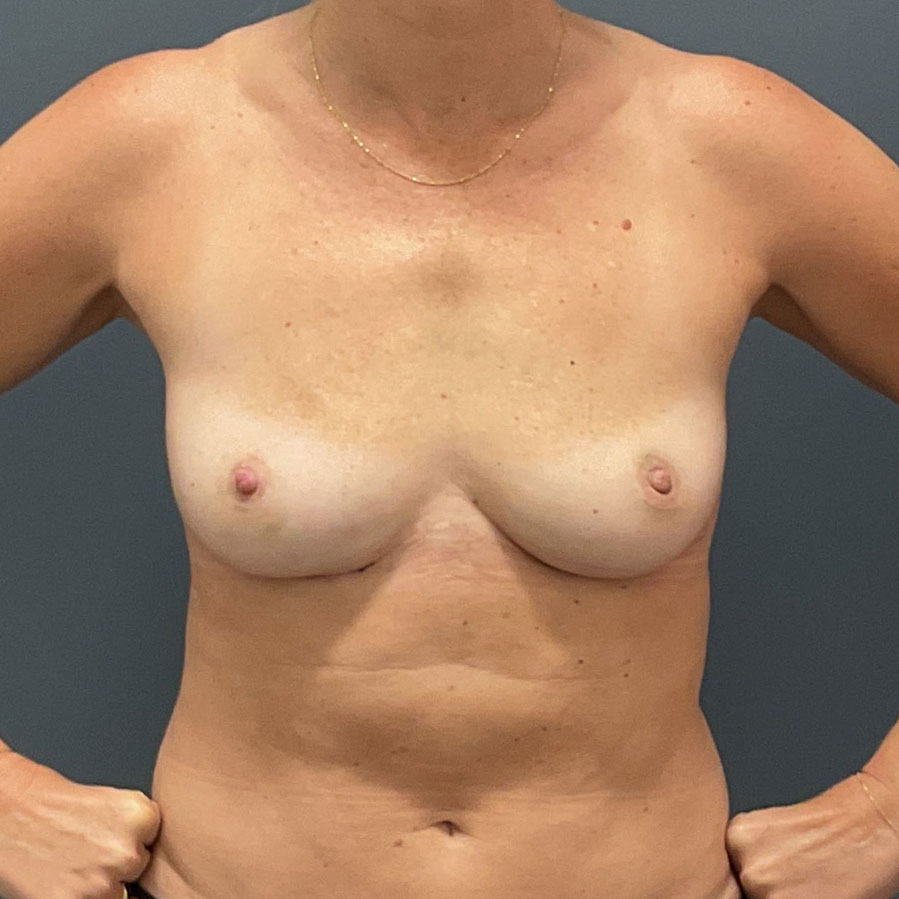 Case--4130 | After En Bloc + Fat Grafting Only 1