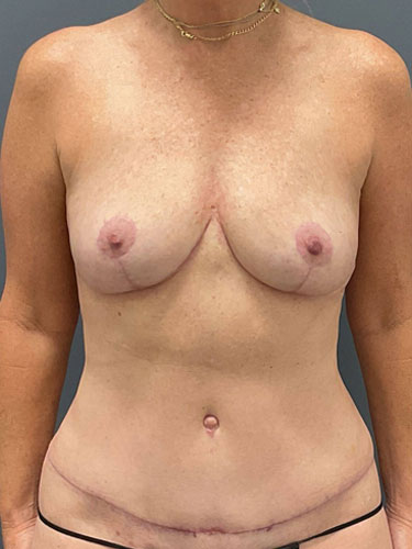 Case--4734 | After Mommy Makeover 1