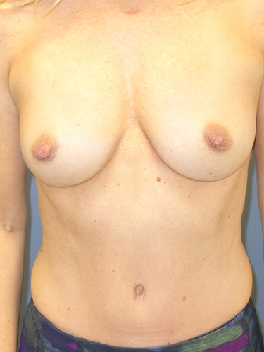 Mommy-Makeover-Patient-02 | After Mommy Makeover